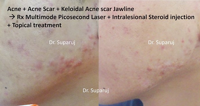 ดูแลแผลเป็นนูน คีลอยด์ ด้วยเทคนิค Triple Laser Therapy: Picosecond Laser + Gold Toning + Fractional Laser + ฉีดยา Intralesional In ดูแลแผลเป็นนูน คีลอยด์ ด้วยเทคนิค Triple Laser Therapy: Picosecond Laser + Gold Toning + Fractional Laser + ฉีดยา Intralesional In