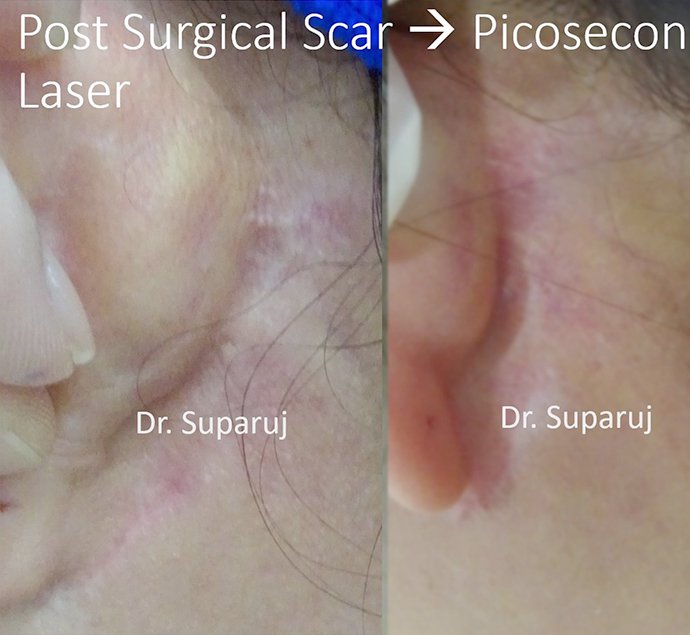 ดูแลแผลเป็นนูน คีลอยด์ ด้วยเทคนิค Triple Laser Therapy: Picosecond Laser + Gold Toning + Fractional Laser + ฉีดยา Intralesional In ดูแลแผลเป็นนูน คีลอยด์ ด้วยเทคนิค Triple Laser Therapy: Picosecond Laser + Gold Toning + Fractional Laser + ฉีดยา Intralesional In