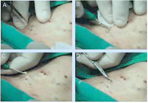 ก้อนซีสต์ Steatocystoma Multiplex คืออะไร รักษาได้อย่างไร ?