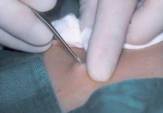 ก้อนซีสต์ Steatocystoma Multiplex คืออะไร รักษาได้อย่างไร ? ก้อนซีสต์ Steatocystoma Multiplex คืออะไร รักษาได้อย่างไร ?