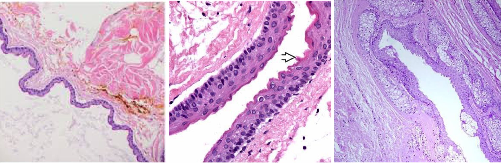 ก้อนซีสต์ Steatocystoma Multiplex คืออะไร รักษาได้อย่างไร ?