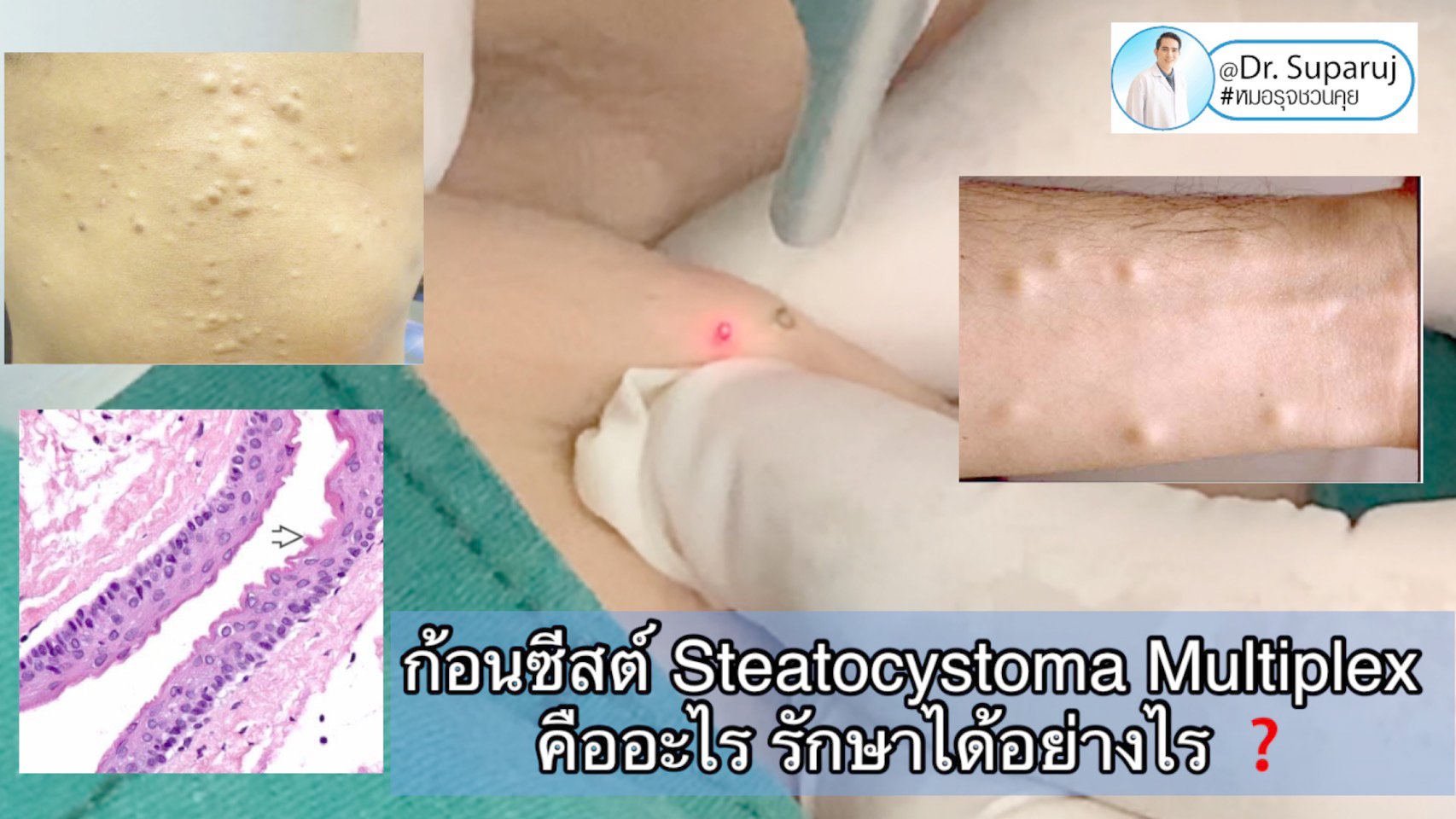 ก้อนซีสต์ Steatocystoma Multiplex คืออะไร รักษาได้อย่างไร ? ก้อนซีสต์ Steatocystoma Multiplex คืออะไร รักษาได้อย่างไร ?