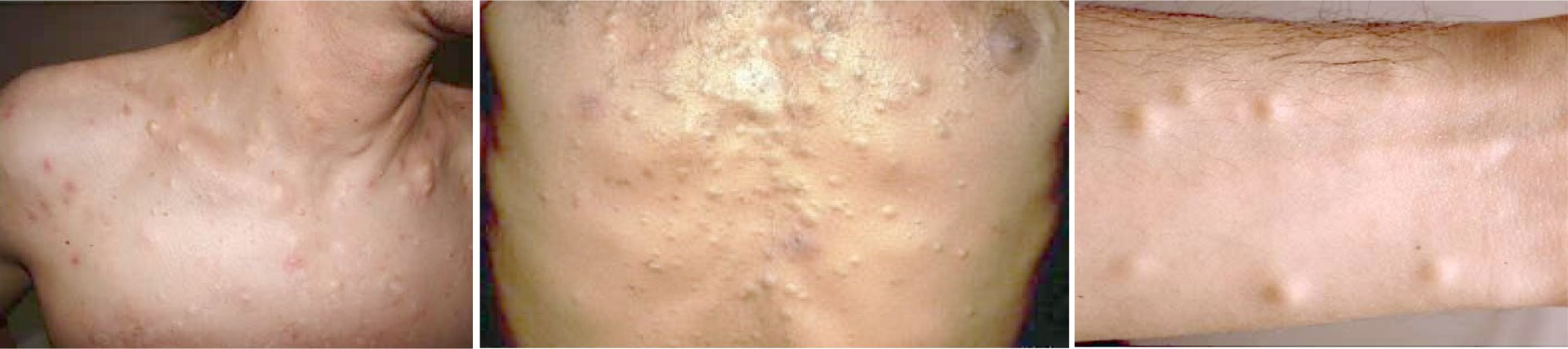 ก้อนซีสต์ Steatocystoma Multiplex คืออะไร รักษาได้อย่างไร ? ก้อนซีสต์ Steatocystoma Multiplex คืออะไร รักษาได้อย่างไร ?