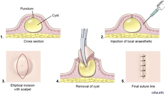 ก้อนซีสต์ Steatocystoma Multiplex คืออะไร รักษาได้อย่างไร ? ก้อนซีสต์ Steatocystoma Multiplex คืออะไร รักษาได้อย่างไร ?