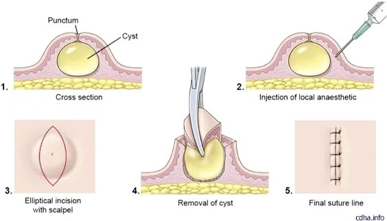 ก้อนซีสต์ Steatocystoma Multiplex คืออะไร รักษาได้อย่างไร ?