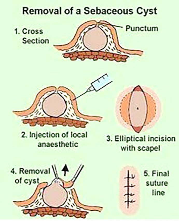 ก้อนซีสต์ Steatocystoma Multiplex คืออะไร รักษาได้อย่างไร ? ก้อนซีสต์ Steatocystoma Multiplex คืออะไร รักษาได้อย่างไร ?