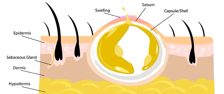 ก้อนซีสต์ Steatocystoma Multiplex คืออะไร รักษาได้อย่างไร ? ก้อนซีสต์ Steatocystoma Multiplex คืออะไร รักษาได้อย่างไร ?