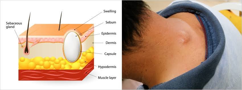 ก้อนซีสต์ Steatocystoma Multiplex คืออะไร รักษาได้อย่างไร ? ก้อนซีสต์ Steatocystoma Multiplex คืออะไร รักษาได้อย่างไร ?