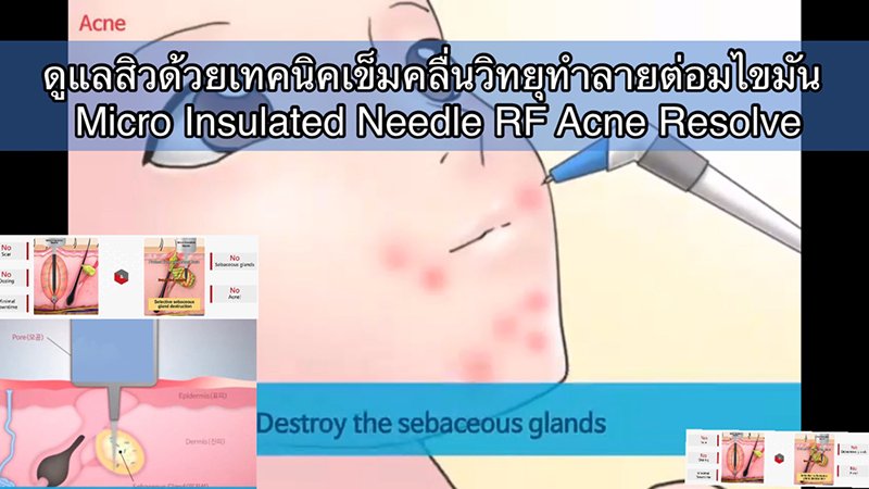 ดูแลรักษาสิวด้วยเทคนิคเข็มคลื่นวิทยุทำลายต่อมไขมัน Micro Insulated Needle RF Acne Resolve