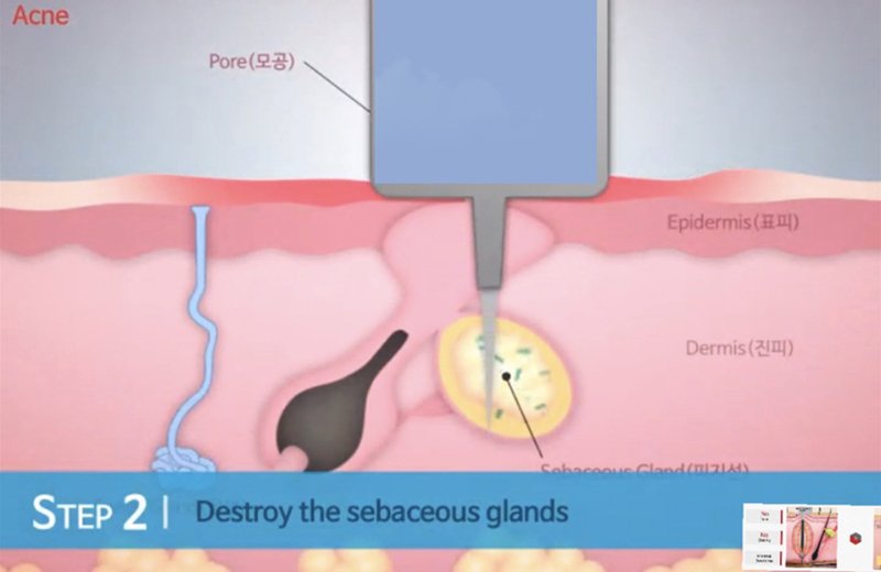 ดูแลรักษาสิวด้วยเทคนิคเข็มคลื่นวิทยุทำลายต่อมไขมัน Micro Insulated Needle RF Acne Resolve ดูแลรักษาสิวด้วยเทคนิคเข็มคลื่นวิทยุทำลายต่อมไขมัน Micro Insulated Needle RF Acne Resolve