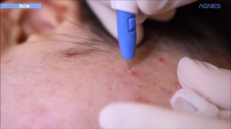 ดูแลรักษาสิวด้วยเทคนิคเข็มคลื่นวิทยุทำลายต่อมไขมัน Micro Insulated Needle RF Acne Resolve ดูแลรักษาสิวด้วยเทคนิคเข็มคลื่นวิทยุทำลายต่อมไขมัน Micro Insulated Needle RF Acne Resolve