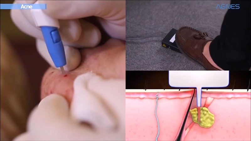 ดูแลรักษาสิวด้วยเทคนิคเข็มคลื่นวิทยุทำลายต่อมไขมัน Micro Insulated Needle RF Acne Resolve ดูแลรักษาสิวด้วยเทคนิคเข็มคลื่นวิทยุทำลายต่อมไขมัน Micro Insulated Needle RF Acne Resolve