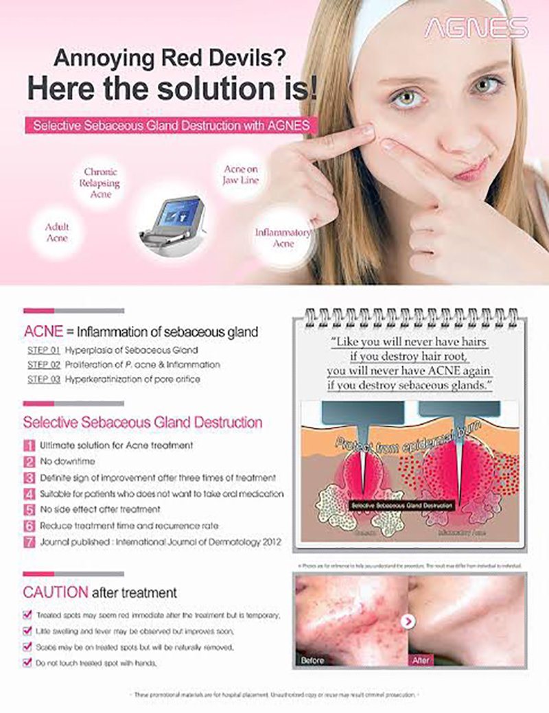 ดูแลรักษาสิวด้วยเทคนิคเข็มคลื่นวิทยุทำลายต่อมไขมัน Micro Insulated Needle RF Acne Resolve ดูแลรักษาสิวด้วยเทคนิคเข็มคลื่นวิทยุทำลายต่อมไขมัน Micro Insulated Needle RF Acne Resolve