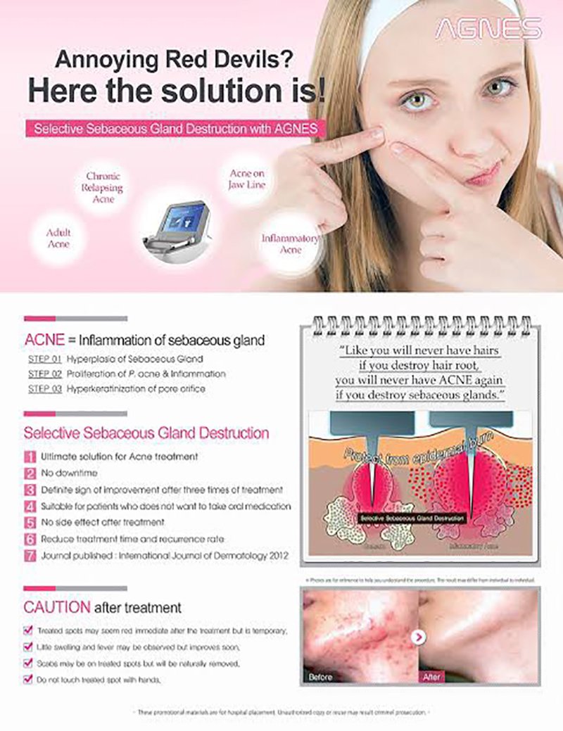 ดูแลรักษาสิวด้วยเทคนิคเข็มคลื่นวิทยุทำลายต่อมไขมัน Micro Insulated Needle RF Acne Resolve