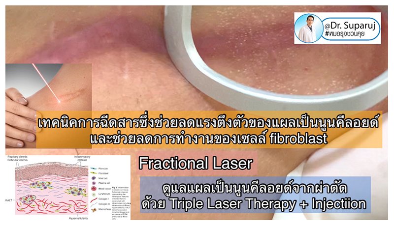 เทคนิคการฉีดสารซึ่งช่วยลดแรงตึงตัวของแผลเป็นนูนคีลอยด์และช่วยลดการทำงานของเซลล์ fibroblast เทคนิคการฉีดสารซึ่งช่วยลดแรงตึงตัวของแผลเป็นนูนคีลอยด์และช่วยลดการทำงานของเซลล์ fibroblast