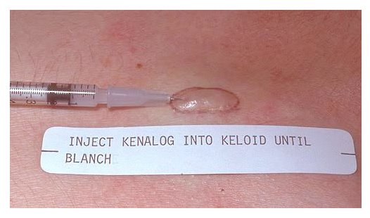 เทคนิคการฉีดสารซึ่งช่วยลดแรงตึงตัวของแผลเป็นนูนคีลอยด์และช่วยลดการทำงานของเซลล์ fibroblast เทคนิคการฉีดสารซึ่งช่วยลดแรงตึงตัวของแผลเป็นนูนคีลอยด์และช่วยลดการทำงานของเซลล์ fibroblast