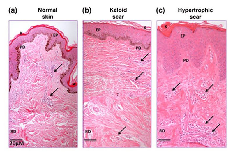 เทคนิคการฉีดสารซึ่งช่วยลดแรงตึงตัวของแผลเป็นนูนคีลอยด์และช่วยลดการทำงานของเซลล์ fibroblast เทคนิคการฉีดสารซึ่งช่วยลดแรงตึงตัวของแผลเป็นนูนคีลอยด์และช่วยลดการทำงานของเซลล์ fibroblast