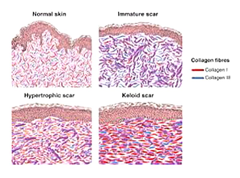 เทคนิคการฉีดสารซึ่งช่วยลดแรงตึงตัวของแผลเป็นนูนคีลอยด์และช่วยลดการทำงานของเซลล์ fibroblast เทคนิคการฉีดสารซึ่งช่วยลดแรงตึงตัวของแผลเป็นนูนคีลอยด์และช่วยลดการทำงานของเซลล์ fibroblast