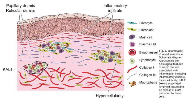 เทคนิคการฉีดสารซึ่งช่วยลดแรงตึงตัวของแผลเป็นนูนคีลอยด์และช่วยลดการทำงานของเซลล์ fibroblast เทคนิคการฉีดสารซึ่งช่วยลดแรงตึงตัวของแผลเป็นนูนคีลอยด์และช่วยลดการทำงานของเซลล์ fibroblast