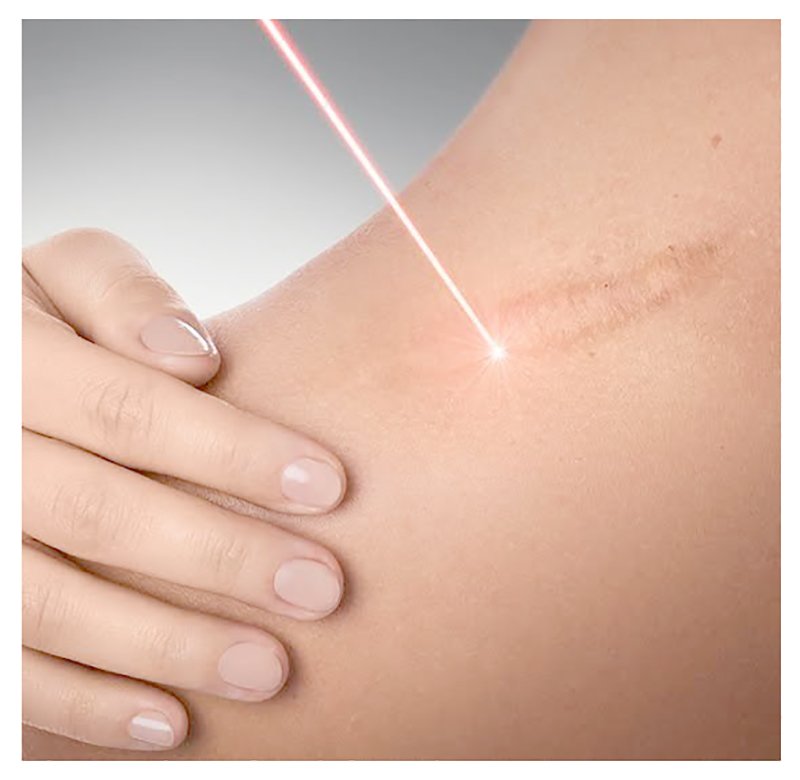 Update เทคนิคการรักษาแผลเป็นคีลอยด์ 2021 Update Scar and Keloid Management Update เทคนิคการรักษาแผลเป็นคีลอยด์ 2021 Update Scar and Keloid Management