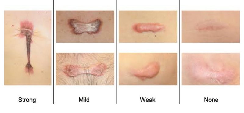 Update เทคนิคการรักษาแผลเป็นคีลอยด์ 2021 Update Scar and Keloid Management Update เทคนิคการรักษาแผลเป็นคีลอยด์ 2021 Update Scar and Keloid Management
