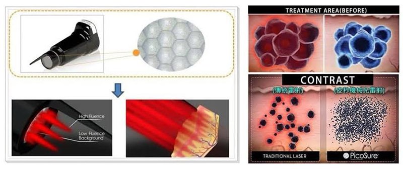 เทคนิคการฉีดสารซึ่งช่วยลดแรงตึงตัวของแผลเป็นนูนคีลอยด์และช่วยลดการทำงานของเซลล์ fibroblast เทคนิคการฉีดสารซึ่งช่วยลดแรงตึงตัวของแผลเป็นนูนคีลอยด์และช่วยลดการทำงานของเซลล์ fibroblast