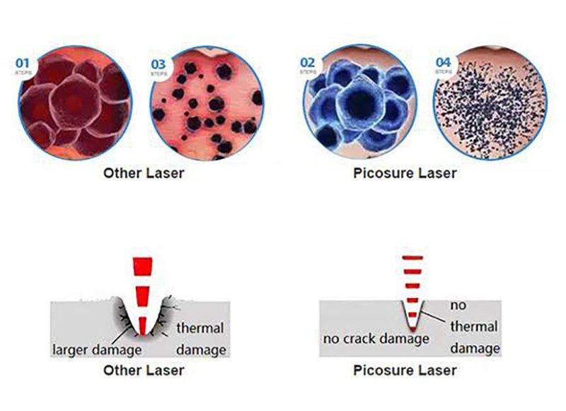 เทคนิคการฉีดสารซึ่งช่วยลดแรงตึงตัวของแผลเป็นนูนคีลอยด์และช่วยลดการทำงานของเซลล์ fibroblast เทคนิคการฉีดสารซึ่งช่วยลดแรงตึงตัวของแผลเป็นนูนคีลอยด์และช่วยลดการทำงานของเซลล์ fibroblast