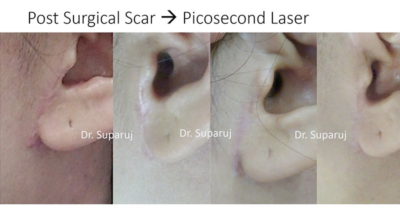 เทคนิคการฉีดสารซึ่งช่วยลดแรงตึงตัวของแผลเป็นนูนคีลอยด์และช่วยลดการทำงานของเซลล์ fibroblast เทคนิคการฉีดสารซึ่งช่วยลดแรงตึงตัวของแผลเป็นนูนคีลอยด์และช่วยลดการทำงานของเซลล์ fibroblast