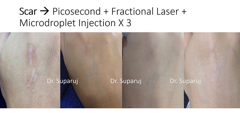 Update เทคนิคการรักษาแผลเป็นคีลอยด์ 2021 Update Scar and Keloid Management Update เทคนิคการรักษาแผลเป็นคีลอยด์ 2021 Update Scar and Keloid Management