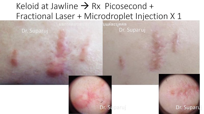 Update เทคนิคการรักษาแผลเป็นคีลอยด์ 2021 Update Scar and Keloid Management