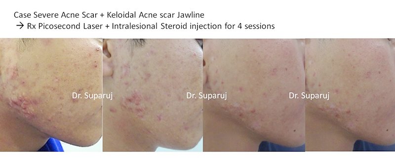 เทคนิคการฉีดสารซึ่งช่วยลดแรงตึงตัวของแผลเป็นนูนคีลอยด์และช่วยลดการทำงานของเซลล์ fibroblast เทคนิคการฉีดสารซึ่งช่วยลดแรงตึงตัวของแผลเป็นนูนคีลอยด์และช่วยลดการทำงานของเซลล์ fibroblast