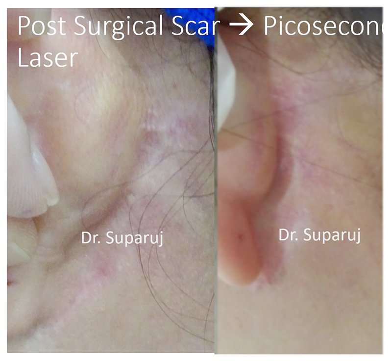 เทคนิคการฉีดสารซึ่งช่วยลดแรงตึงตัวของแผลเป็นนูนคีลอยด์และช่วยลดการทำงานของเซลล์ fibroblast เทคนิคการฉีดสารซึ่งช่วยลดแรงตึงตัวของแผลเป็นนูนคีลอยด์และช่วยลดการทำงานของเซลล์ fibroblast