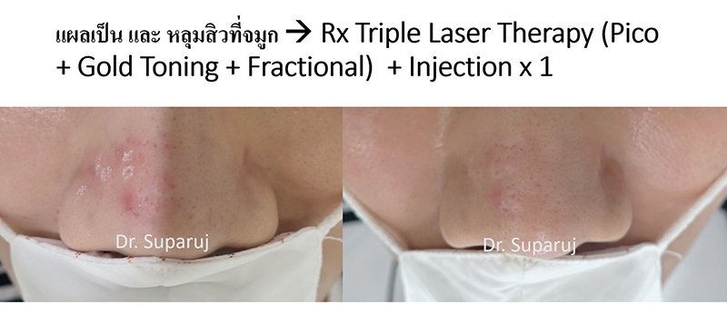 เทคนิคการฉีดสารซึ่งช่วยลดแรงตึงตัวของแผลเป็นนูนคีลอยด์และช่วยลดการทำงานของเซลล์ fibroblast เทคนิคการฉีดสารซึ่งช่วยลดแรงตึงตัวของแผลเป็นนูนคีลอยด์และช่วยลดการทำงานของเซลล์ fibroblast