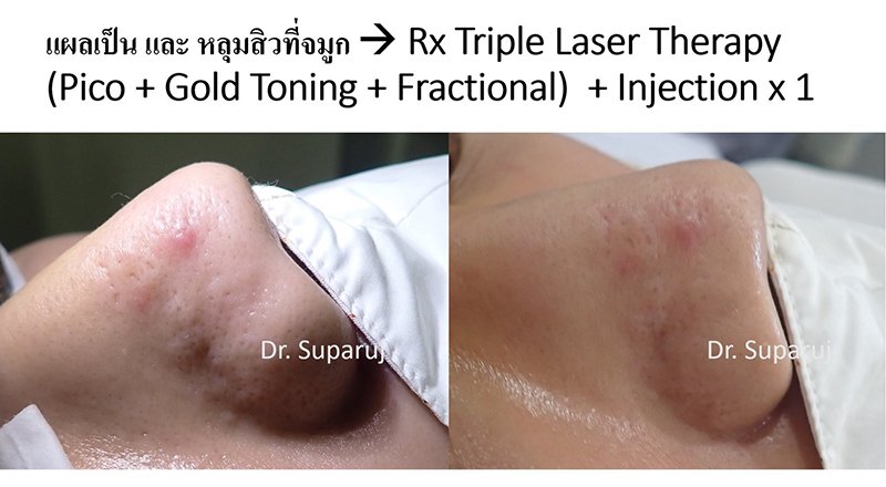 เทคนิคการฉีดสารซึ่งช่วยลดแรงตึงตัวของแผลเป็นนูนคีลอยด์และช่วยลดการทำงานของเซลล์ fibroblast เทคนิคการฉีดสารซึ่งช่วยลดแรงตึงตัวของแผลเป็นนูนคีลอยด์และช่วยลดการทำงานของเซลล์ fibroblast