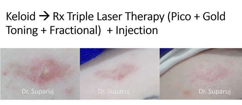 เทคนิคการฉีดสารซึ่งช่วยลดแรงตึงตัวของแผลเป็นนูนคีลอยด์และช่วยลดการทำงานของเซลล์ fibroblast เทคนิคการฉีดสารซึ่งช่วยลดแรงตึงตัวของแผลเป็นนูนคีลอยด์และช่วยลดการทำงานของเซลล์ fibroblast