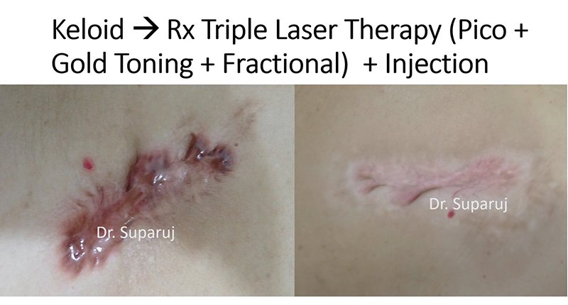 เทคนิคการฉีดสารซึ่งช่วยลดแรงตึงตัวของแผลเป็นนูนคีลอยด์และช่วยลดการทำงานของเซลล์ fibroblast เทคนิคการฉีดสารซึ่งช่วยลดแรงตึงตัวของแผลเป็นนูนคีลอยด์และช่วยลดการทำงานของเซลล์ fibroblast
