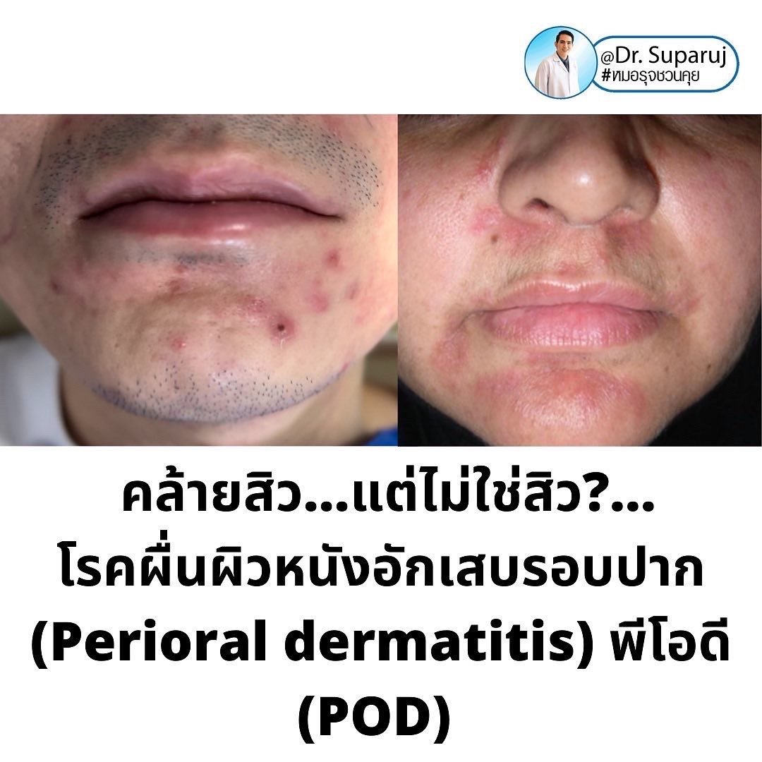 คล้ายสิว…แต่ไม่ใช่สิว… …ผื่นผิวหนังอักเสบรอบปาก (Perioral dermatitis, POD) คล้ายสิว…แต่ไม่ใช่สิว… …ผื่นผิวหนังอักเสบรอบปาก (Perioral dermatitis, POD)