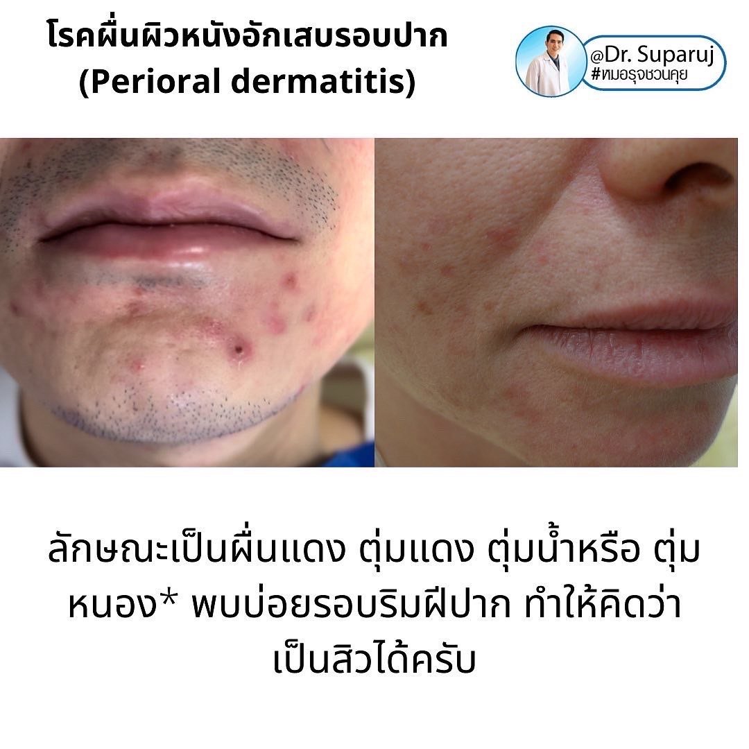 คล้ายสิว…แต่ไม่ใช่สิว… …ผื่นผิวหนังอักเสบรอบปาก (Perioral dermatitis, POD) คล้ายสิว…แต่ไม่ใช่สิว… …ผื่นผิวหนังอักเสบรอบปาก (Perioral dermatitis, POD)