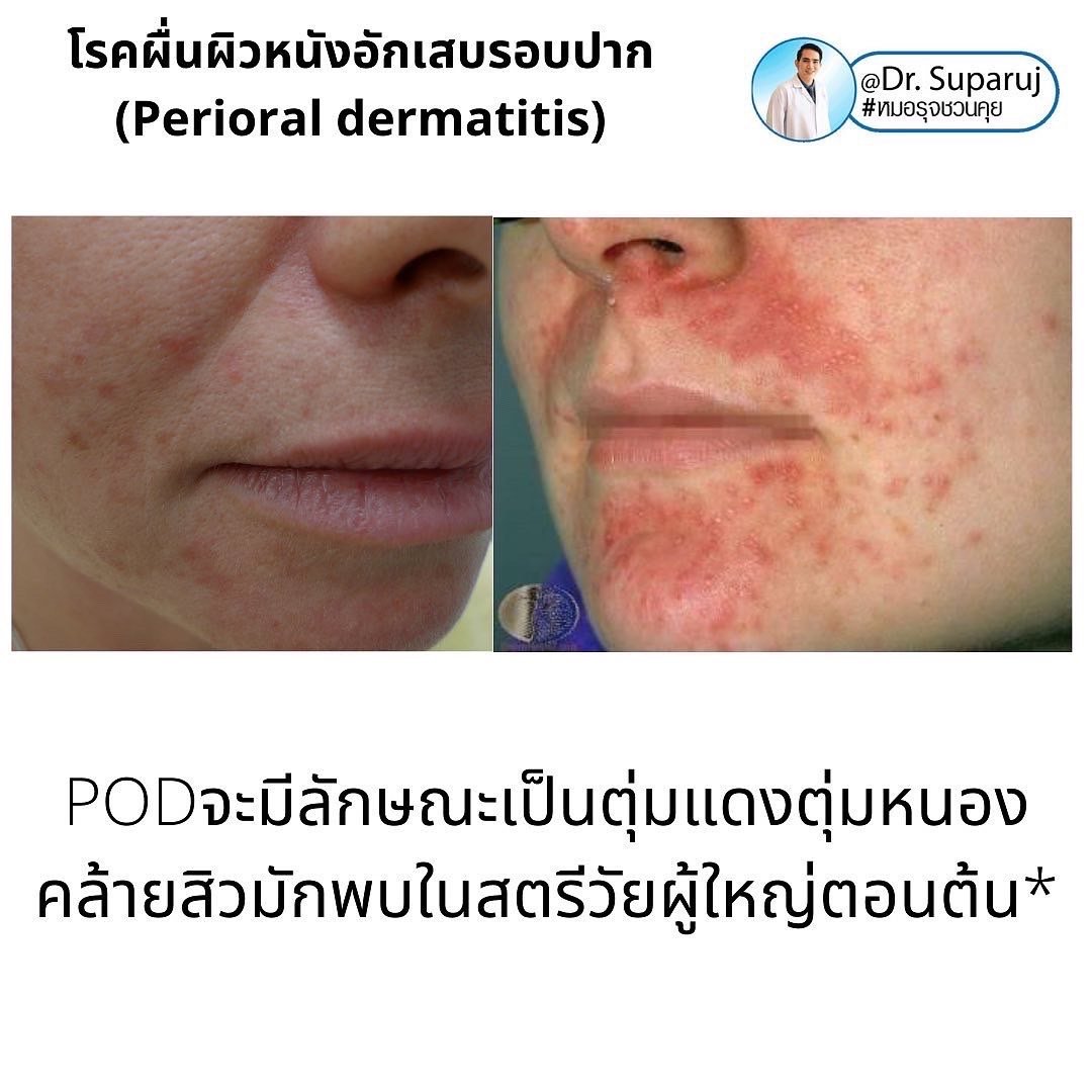 คล้ายสิว…แต่ไม่ใช่สิว… …ผื่นผิวหนังอักเสบรอบปาก (Perioral dermatitis, POD) คล้ายสิว…แต่ไม่ใช่สิว… …ผื่นผิวหนังอักเสบรอบปาก (Perioral dermatitis, POD)