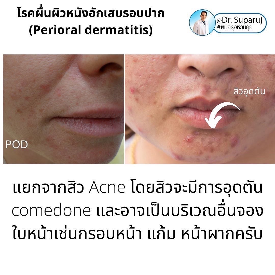 คล้ายสิว…แต่ไม่ใช่สิว… …ผื่นผิวหนังอักเสบรอบปาก (Perioral dermatitis, POD) คล้ายสิว…แต่ไม่ใช่สิว… …ผื่นผิวหนังอักเสบรอบปาก (Perioral dermatitis, POD)