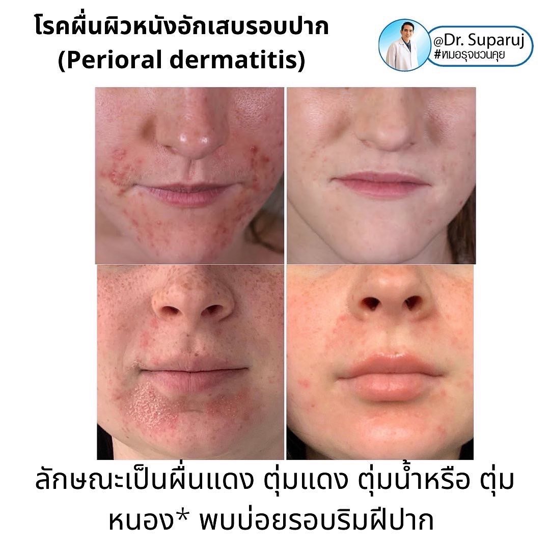 คล้ายสิว…แต่ไม่ใช่สิว… …ผื่นผิวหนังอักเสบรอบปาก (Perioral dermatitis, POD) คล้ายสิว…แต่ไม่ใช่สิว… …ผื่นผิวหนังอักเสบรอบปาก (Perioral dermatitis, POD)