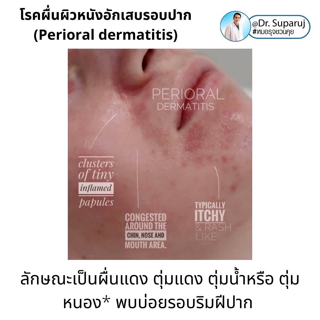 คล้ายสิว…แต่ไม่ใช่สิว… …ผื่นผิวหนังอักเสบรอบปาก (Perioral dermatitis, POD) คล้ายสิว…แต่ไม่ใช่สิว… …ผื่นผิวหนังอักเสบรอบปาก (Perioral dermatitis, POD)