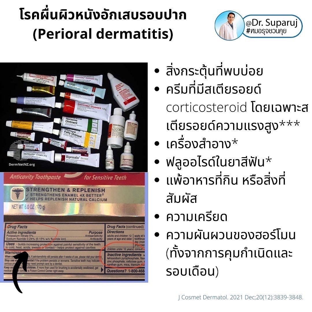 คล้ายสิว…แต่ไม่ใช่สิว… …ผื่นผิวหนังอักเสบรอบปาก (Perioral dermatitis, POD) คล้ายสิว…แต่ไม่ใช่สิว… …ผื่นผิวหนังอักเสบรอบปาก (Perioral dermatitis, POD)