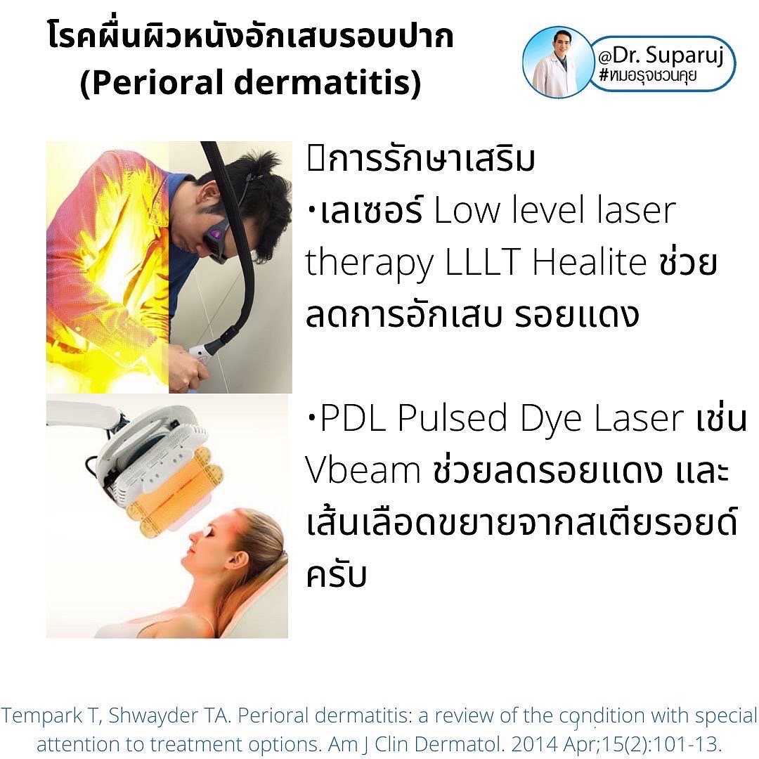 คล้ายสิว…แต่ไม่ใช่สิว… …ผื่นผิวหนังอักเสบรอบปาก (Perioral dermatitis, POD) คล้ายสิว…แต่ไม่ใช่สิว… …ผื่นผิวหนังอักเสบรอบปาก (Perioral dermatitis, POD)