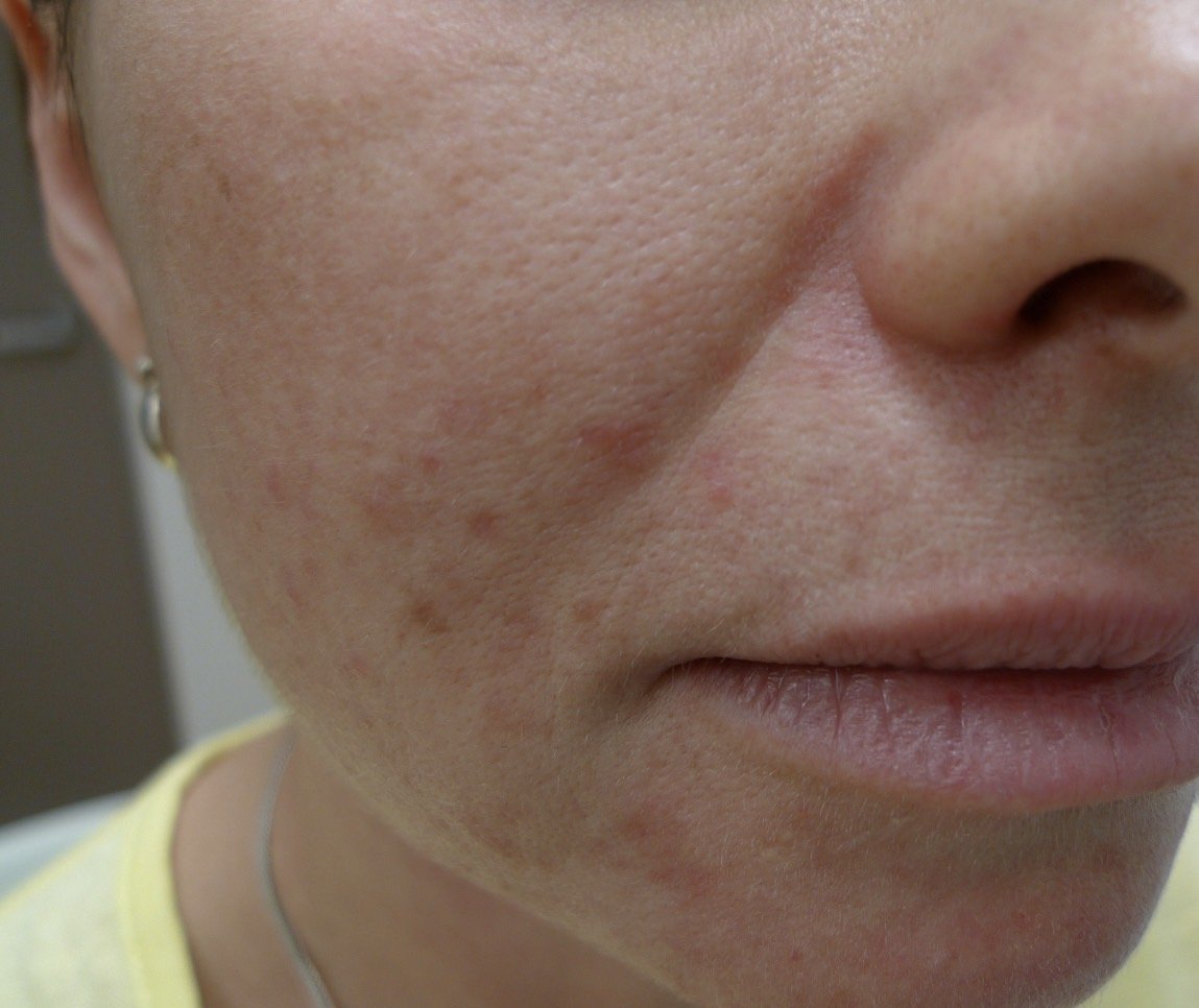 คล้ายสิว…แต่ไม่ใช่สิว… …ผื่นผิวหนังอักเสบรอบปาก (Perioral dermatitis, POD) คล้ายสิว…แต่ไม่ใช่สิว… …ผื่นผิวหนังอักเสบรอบปาก (Perioral dermatitis, POD)