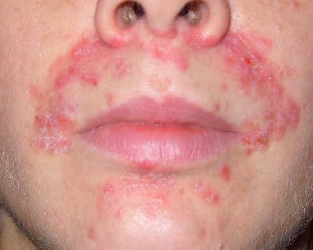 คล้ายสิว…แต่ไม่ใช่สิว… …ผื่นผิวหนังอักเสบรอบปาก (Perioral dermatitis, POD)