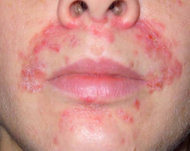 คล้ายสิว…แต่ไม่ใช่สิว… …ผื่นผิวหนังอักเสบรอบปาก (Perioral dermatitis, POD) คล้ายสิว…แต่ไม่ใช่สิว… …ผื่นผิวหนังอักเสบรอบปาก (Perioral dermatitis, POD)