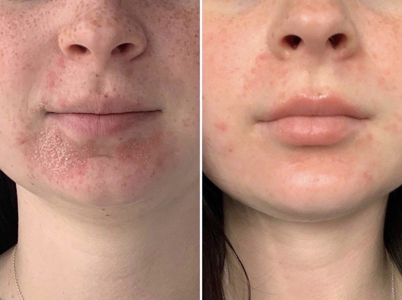 คล้ายสิว…แต่ไม่ใช่สิว… …ผื่นผิวหนังอักเสบรอบปาก (Perioral dermatitis, POD) คล้ายสิว…แต่ไม่ใช่สิว… …ผื่นผิวหนังอักเสบรอบปาก (Perioral dermatitis, POD)