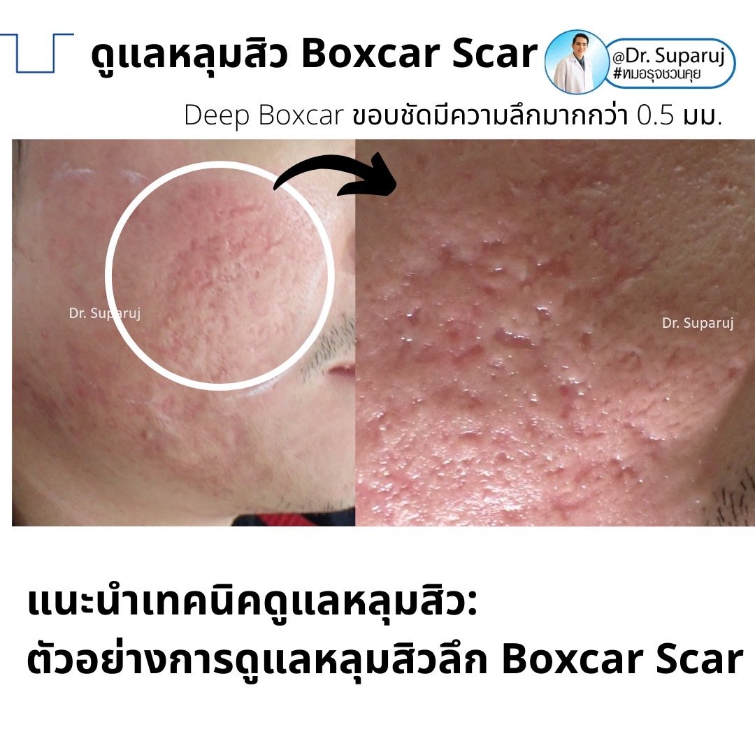 เทคนิคดูแลหลุมสิวลึกขอบชัด Deep Boxcar Scar !!