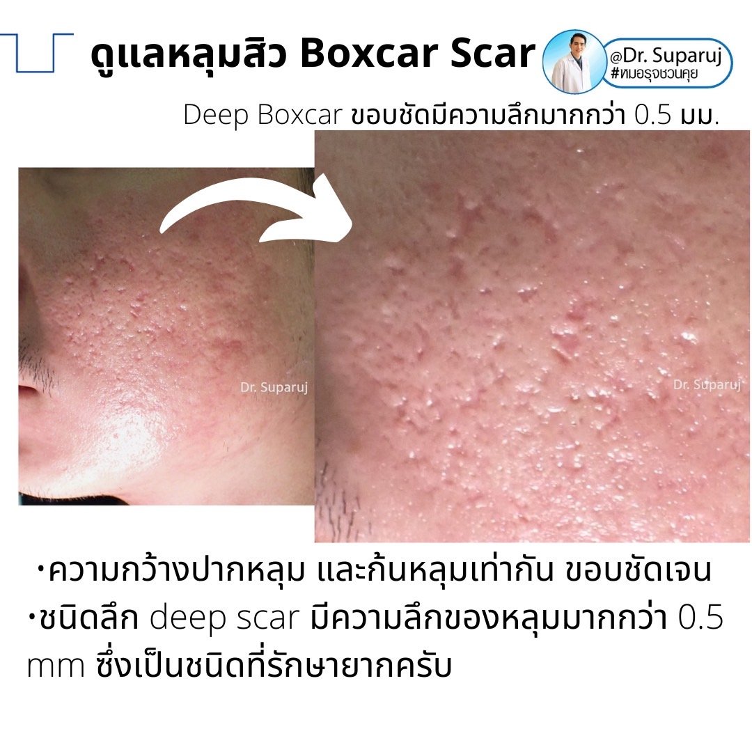 เทคนิคดูแลหลุมสิวลึกขอบชัด Deep Boxcar Scar !!